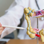 ¿Cuál es el alimento clave para prevenir el cáncer de colon?