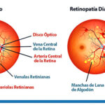 En desarrollo, gotas oftálmicas para prevenir la pérdida de visión en personas con diabetes