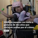Logro histórico: médicos separan con éxito a gemelas de dos años que nacieron unidas por el cráneo